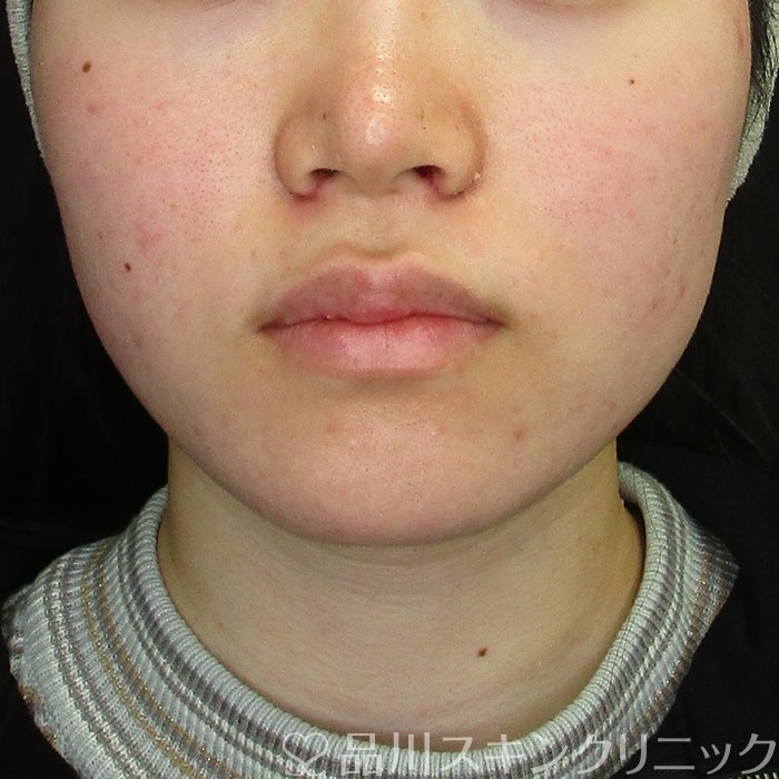 症例NO.73510のAFTER写真