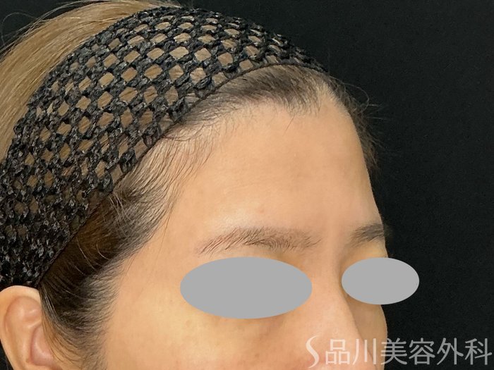 症例NO.71898のBEFORE写真