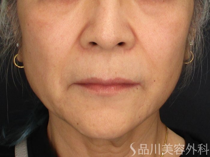 症例NO.73662のBEFORE写真