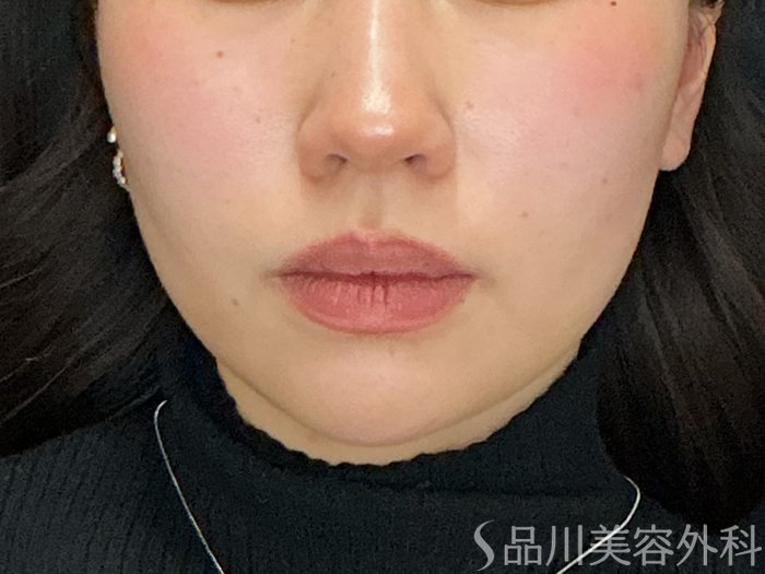 症例NO.72916のBEFORE写真