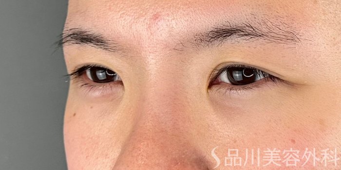 症例NO.70305のBEFORE写真