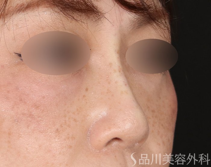 症例NO.71345のAFTER写真