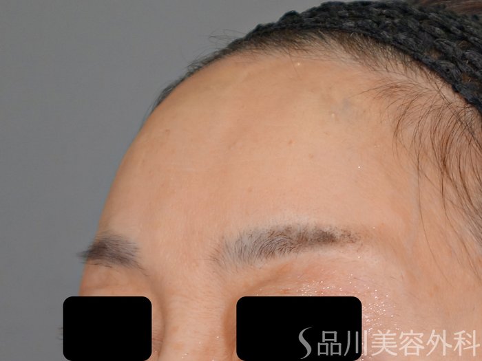症例NO.70541のAFTER写真