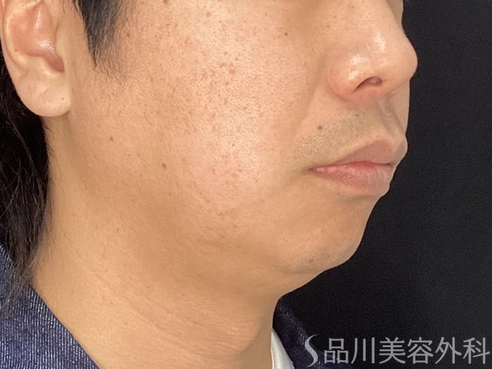 症例NO.75396のBEFORE写真
