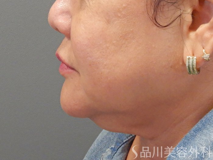 症例NO.71382のBEFORE写真