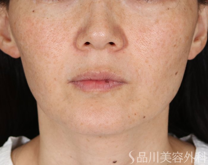 症例NO.74032のBEFORE写真