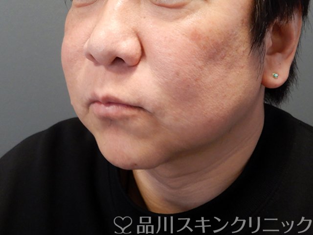 症例NO.68572のBEFORE写真
