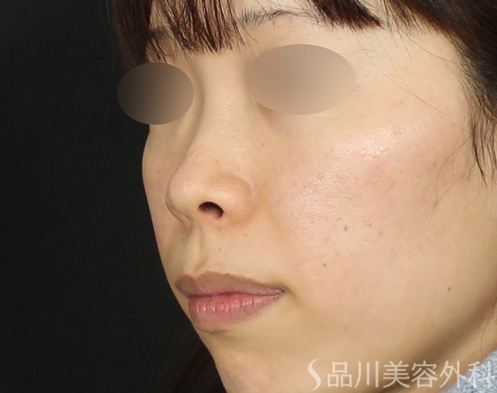 症例NO.72106のBEFORE写真