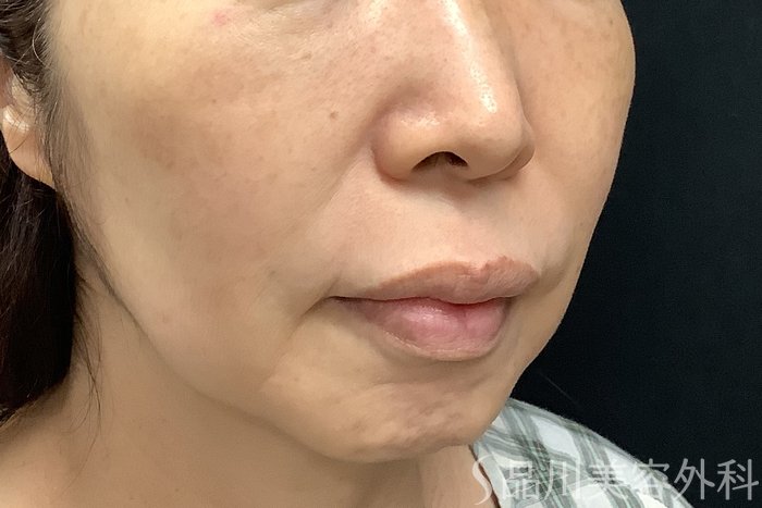 症例NO.71257のBEFORE写真