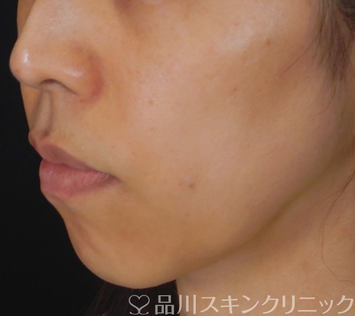 症例NO.67367のBEFORE写真