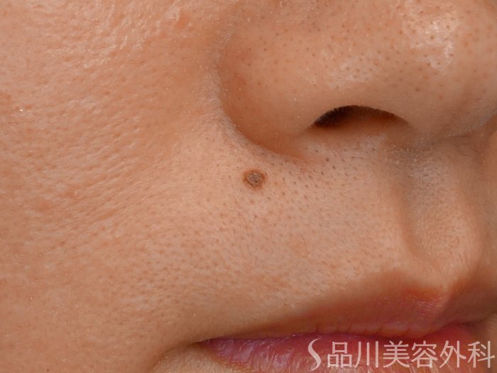 症例NO.72275のBEFORE写真