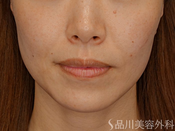 症例NO.73928のBEFORE写真
