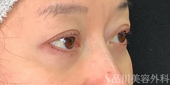 症例NO.71225のAFTER写真