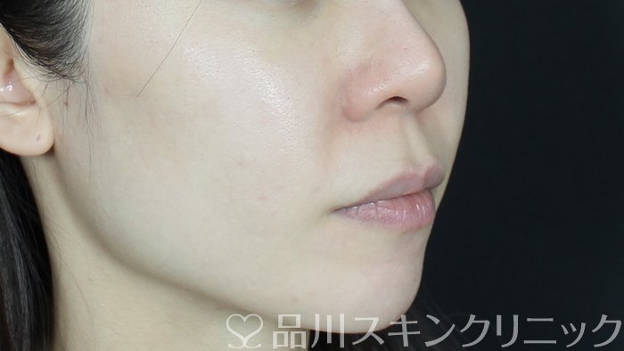症例NO.71676のBEFORE写真
