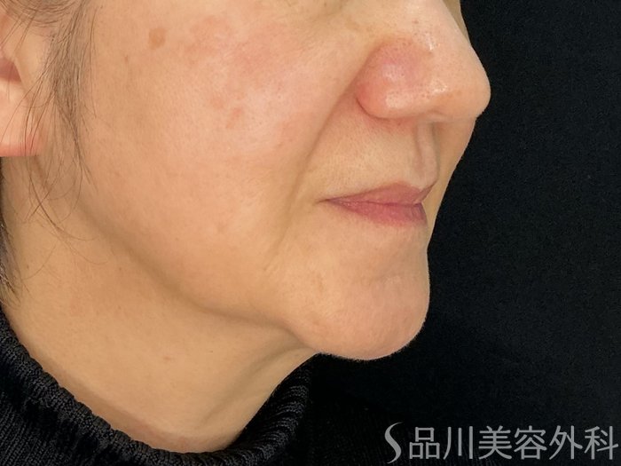 症例NO.72660のBEFORE写真