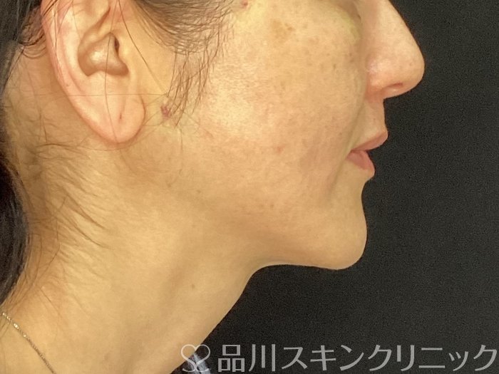 症例NO.72901のAFTER写真