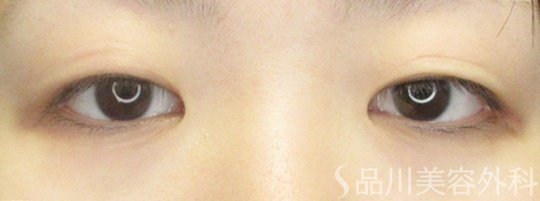 症例NO.69229のBEFORE写真