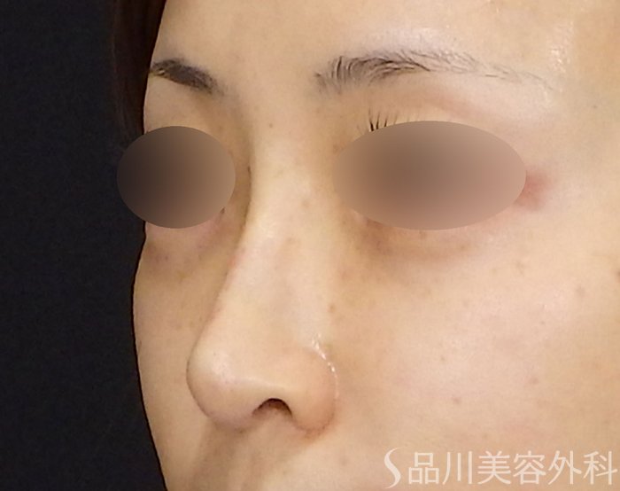 症例NO.71471のAFTER写真