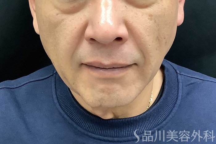 症例NO.69615のBEFORE写真