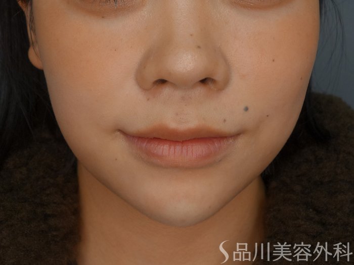 症例NO.73031のAFTER写真