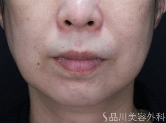 症例NO.71267のBEFORE写真