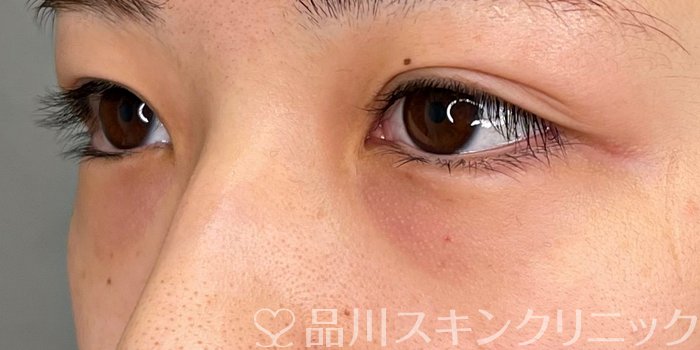 症例NO.69726のBEFORE写真