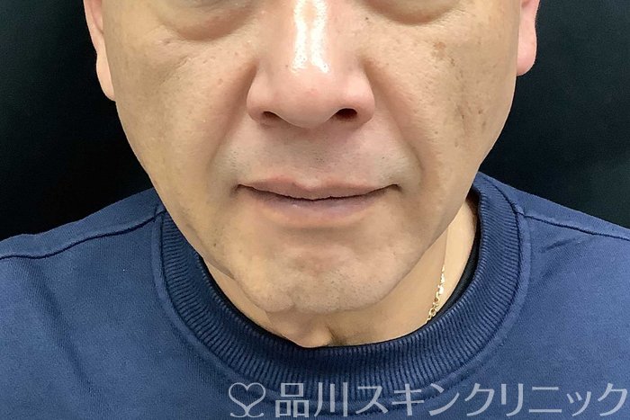 症例NO.69615のBEFORE写真