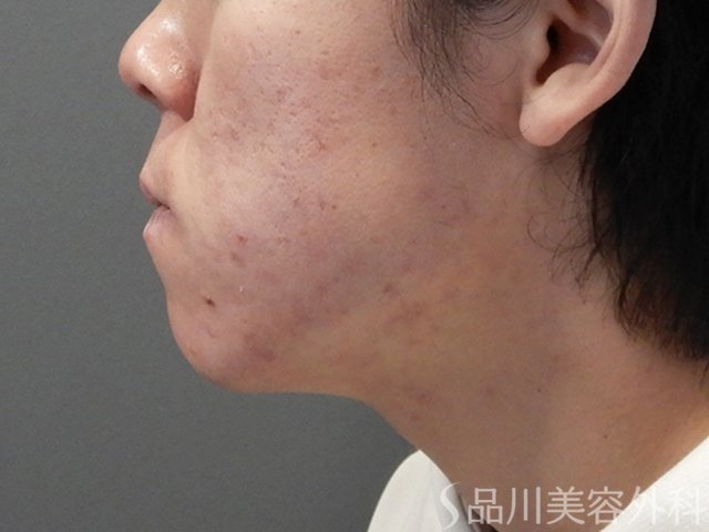 症例NO.69826のAFTER写真