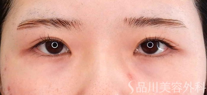 症例NO.62185のBEFORE写真