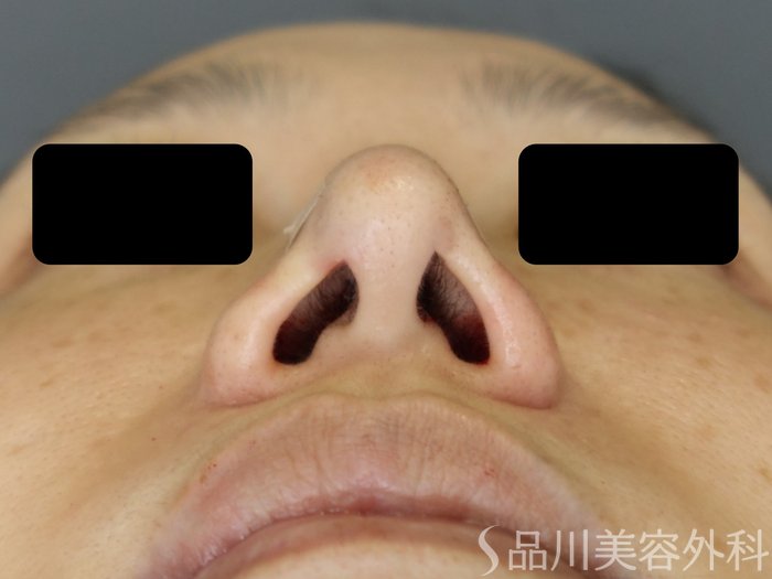 症例NO.71511のAFTER写真