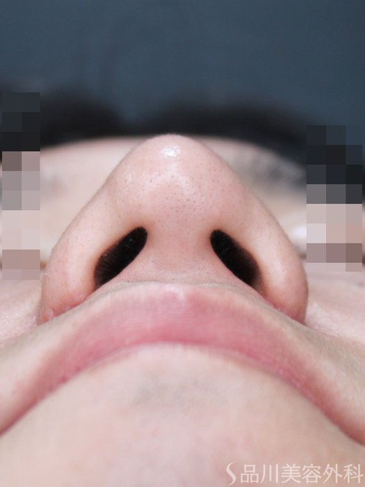症例NO.70034のAFTER写真