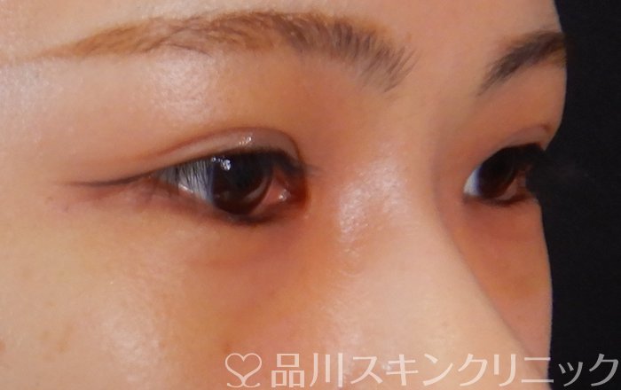 症例NO.66516のBEFORE写真