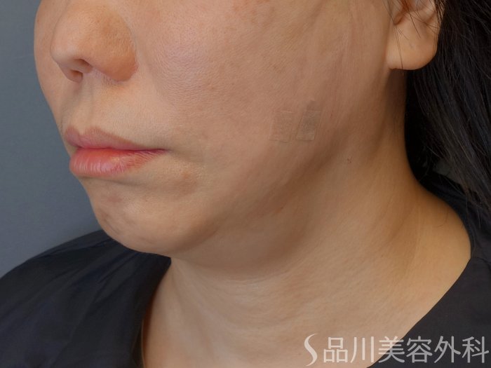 症例NO.72987のAFTER写真