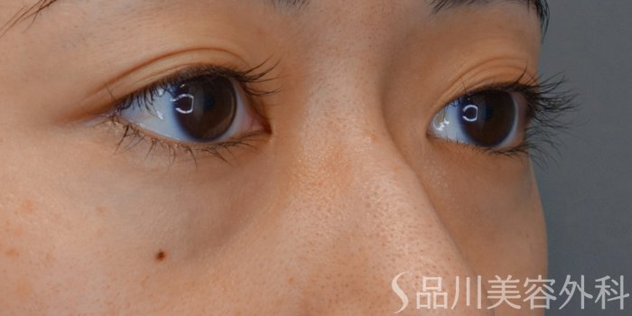 症例NO.71602のBEFORE写真