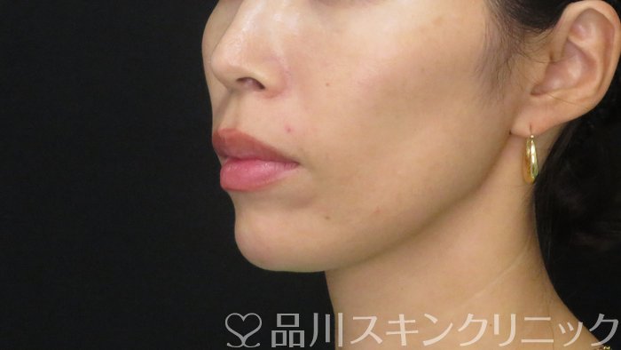 症例NO.72232のAFTER写真