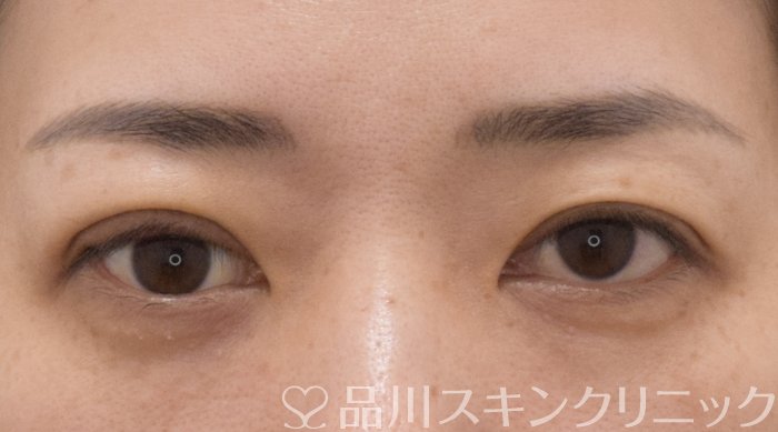 症例NO.70969のAFTER写真