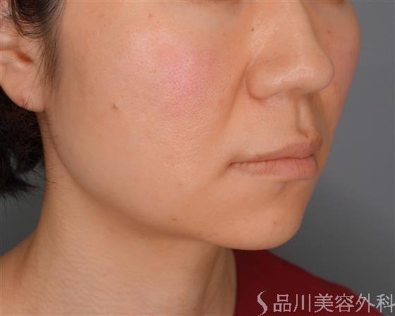 症例NO.53883のBEFORE写真