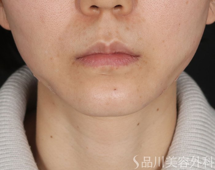 症例NO.72489のAFTER写真