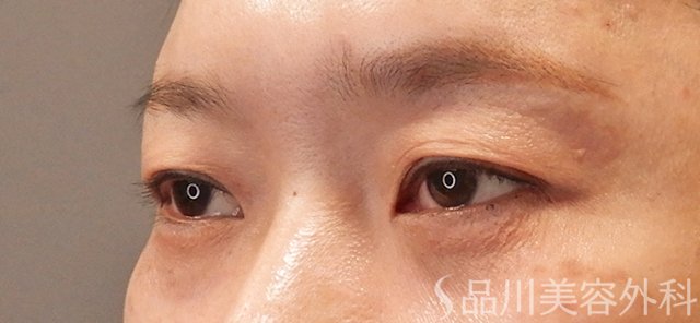 症例NO.72767のAFTER写真