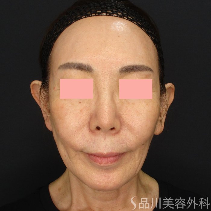 症例NO.72113のAFTER写真