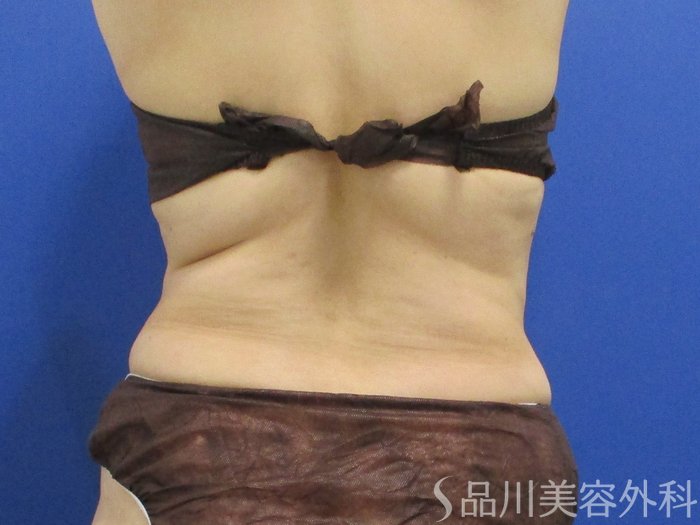 症例NO.70942のBEFORE写真