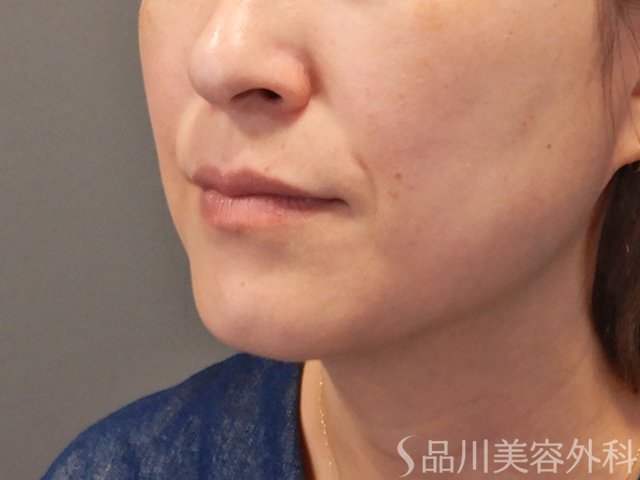 症例NO.74952のBEFORE写真