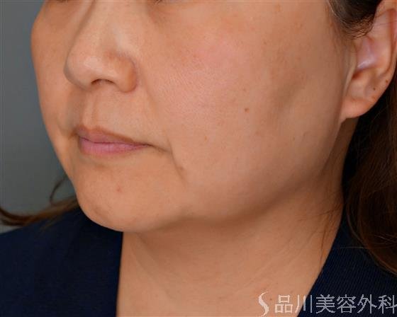 症例NO.53519のBEFORE写真