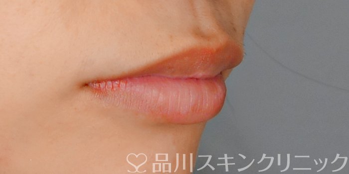 症例NO.70899のBEFORE写真