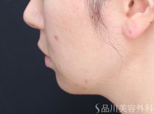 症例NO.73624のBEFORE写真