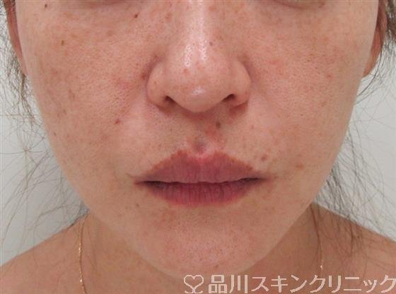 症例NO.32327のBEFORE写真