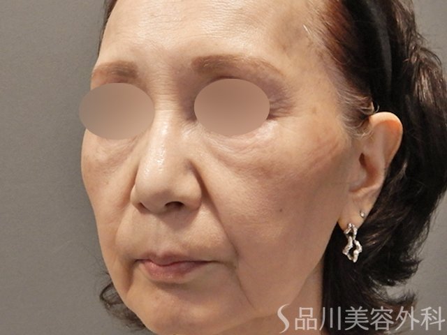 症例NO.74542のAFTER写真