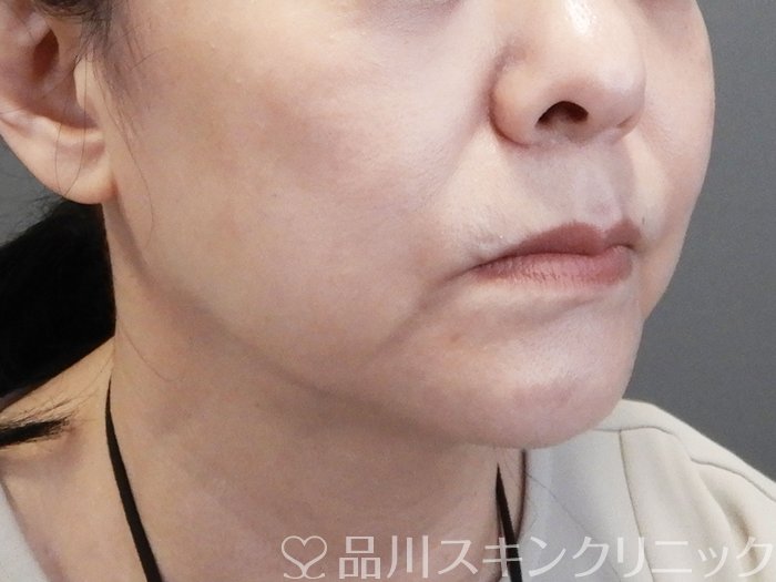 症例NO.75179のBEFORE写真