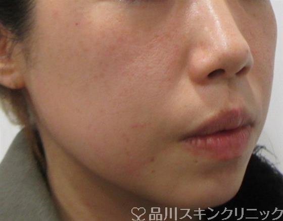 症例NO.26725のAFTER写真