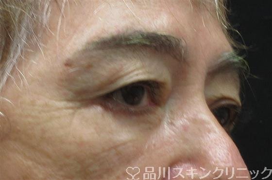 症例NO.61365のAFTER写真